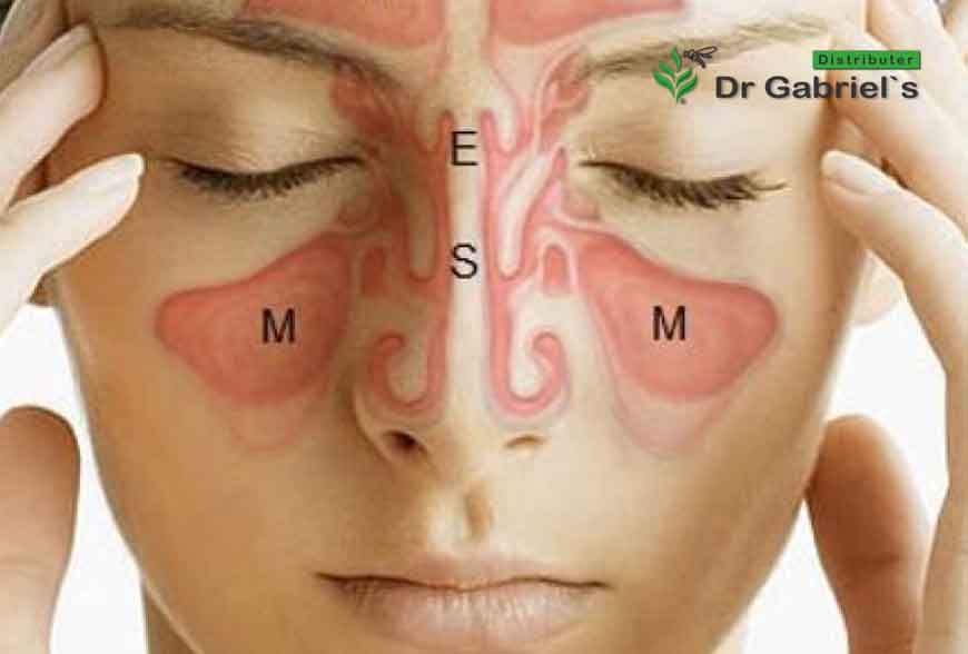 Spriječite upalu sinusa pomoću nekoliko jednostavnih i prirodnih alternativa.